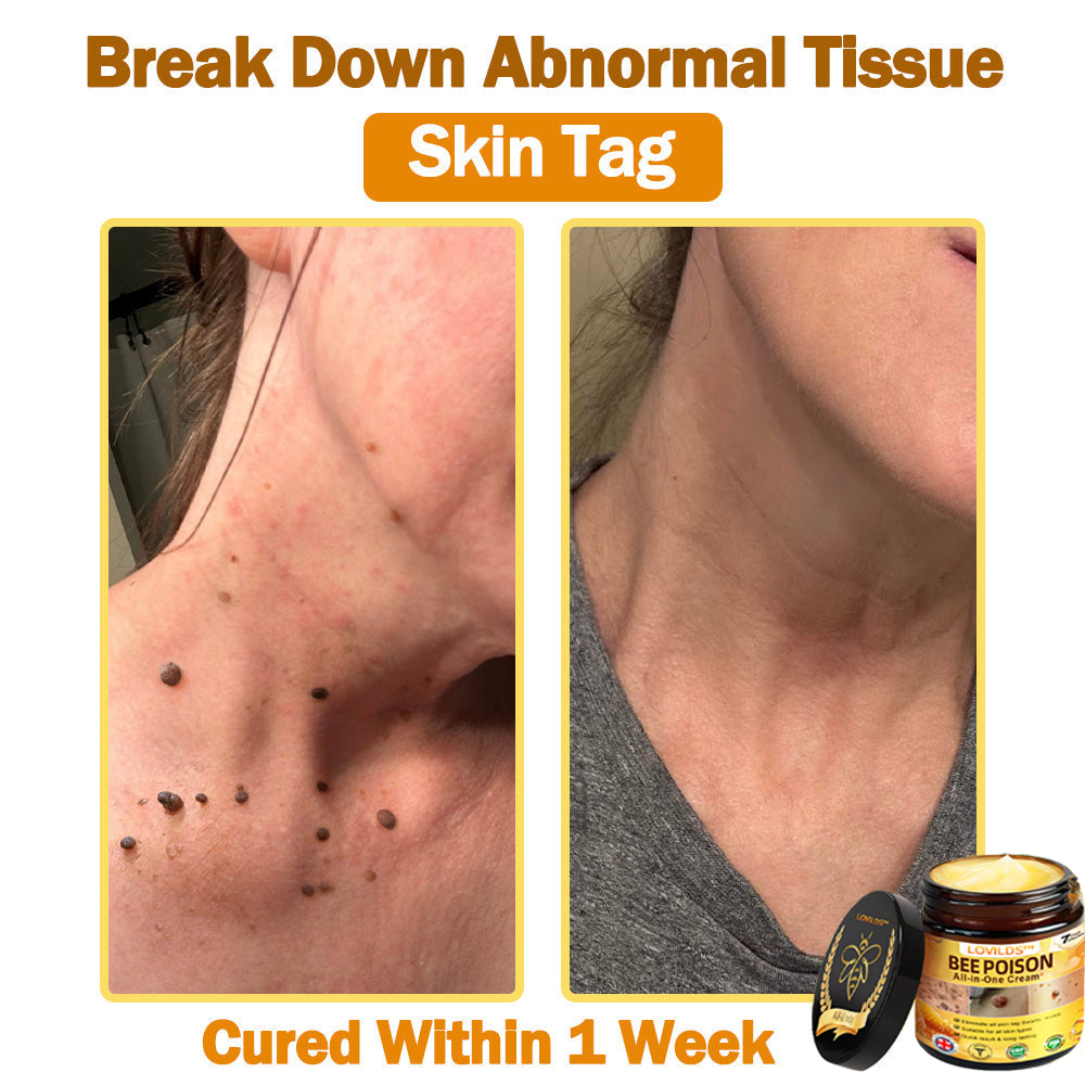 🐝[Official Brand Store] 🐝 LOVILDS™ Bee Venom All-In-One Cream (👩‍⚕️British Association of Dermatology 2025 Special Recommendation)