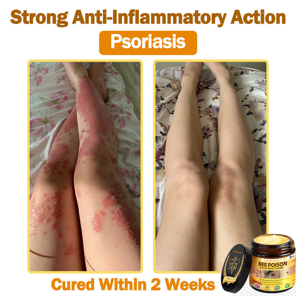 🐝[Official Brand Store] 🐝 LOVILDS™ Bee Venom All-In-One Cream (👩‍⚕️British Association of Dermatology 2025 Special Recommendation)